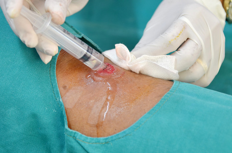 Surgical wound cleaning with antiseptic solution in a sterile medical environment.